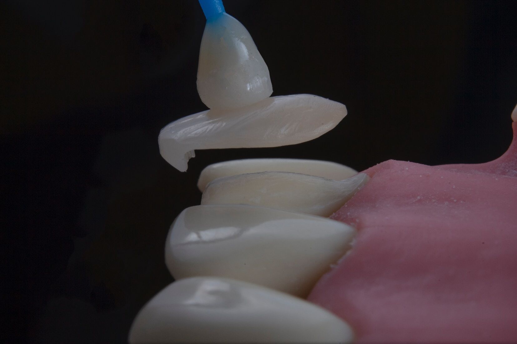 Transform Your Smile with Dental Veneers in Dubai